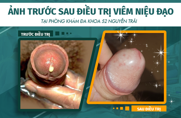 Hình ảnh trước và sau khi điều trị viêm niệu đạo tại phòng khám Đa khoa 52 Nguyễn Trãi