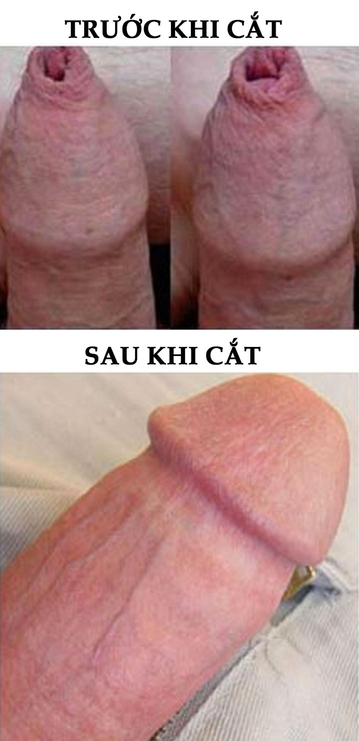 Hình ảnh trước và sau khi cắt bao quy đầu bị dài - Ảnh 01