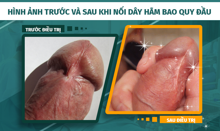 HÌNH ẢNH TRƯỚC VÀ SAU KHI NỐI DÂY HÃM BAO QUY ĐẦU TẠI PHÒNG KHÁM ĐA KHOA 52 NGUYỄN TRÃI HÌNH ẢNH TRƯỚC VÀ SAU KHI NỐI DÂY HÃM BAO QUY ĐẦU TẠI PHÒNG KHÁM ĐA KHOA 52 NGUYỄN TRÃI