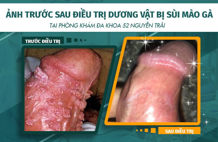Hình ảnh trước và sau khi điều trị bệnh sùi mào gà ở dương vật tại phòng khám Đa khoa 52 Nguyễn Trãi