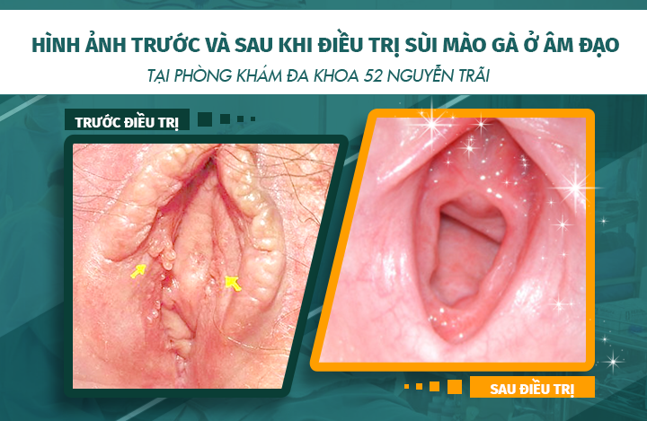 Hình ảnh trước và sau khi điều trị bệnh sùi mào gà ở âm đạo tại phòng khám Đa khoa 52 Nguyễn Trãi