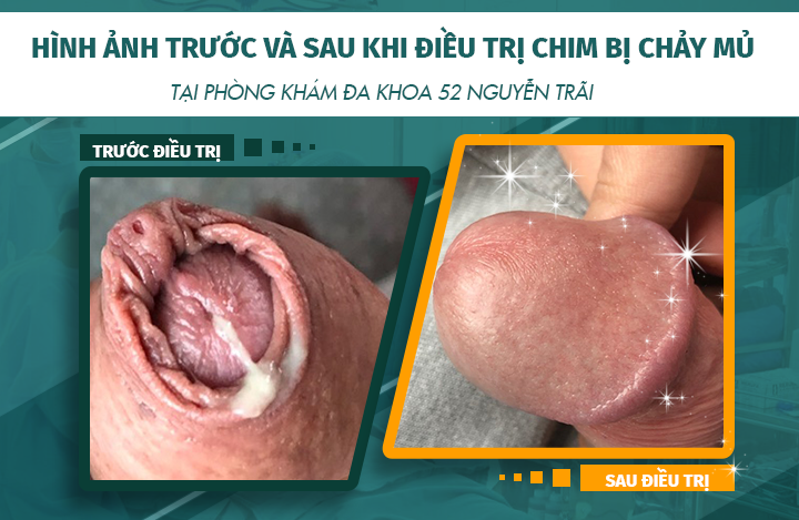 Hình ảnh trước và sau khi điều trị đầu chim chảy mủ tại phòng khám Đa khoa 52 Nguyễn Trãi
