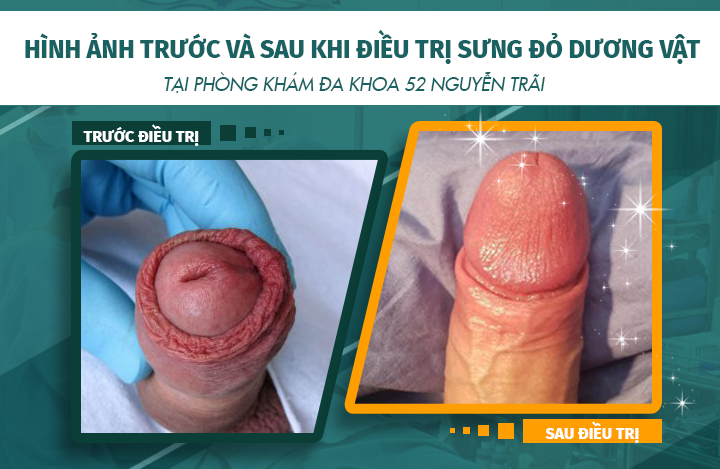 Hình ảnh trước và sau khi điều trị sưng đỏ và ngứa dương vật, đầu dương vật tại phòng khám Đa khoa 52 Nguyễn Trãi