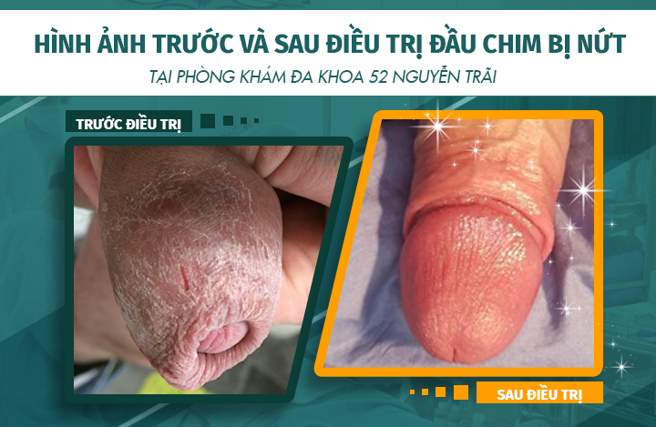 Hình ảnh trước và sau khi điều trị đầu chim bị nứt nẻ tại phòng khám Đa khoa 52 Nguyễn Trãi