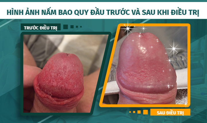 Hình ảnh trước và sau khi điều trị nấm bao quy đầu tại phòng khám Đa khoa 52 Nguyễn Trãi
