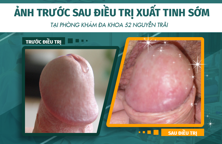 Hình ảnh trước và sau khi điều trị bệnh xuất tinh sớm tại phòng khám Đa khoa 52 Nguyễn Trãi