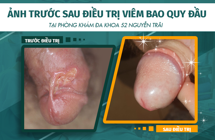 Hình ảnh trước và sau khi điều trị bệnh viêm bao quy đầu dương vật tại phòng khám Đa khoa 52 Nguyễn Trãi