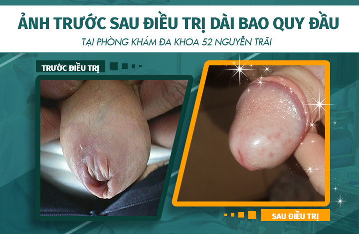Hình ảnh trước và sau khi điều trị bệnh dài bao quy đầu dương vật tại phòng khám Đa khoa 52 Nguyễn Trãi