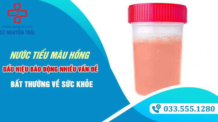 Nước tiểu màu hồng: Dấu hiệu báo động nhiều vấn đề bất thường về sức khỏe Nước tiểu màu hồng: Dấu hiệu báo động nhiều vấn đề bất thường về sức khỏe
