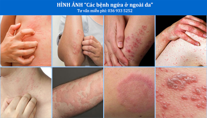Các bệnh ngứa ngoài da có nguy hiểm không