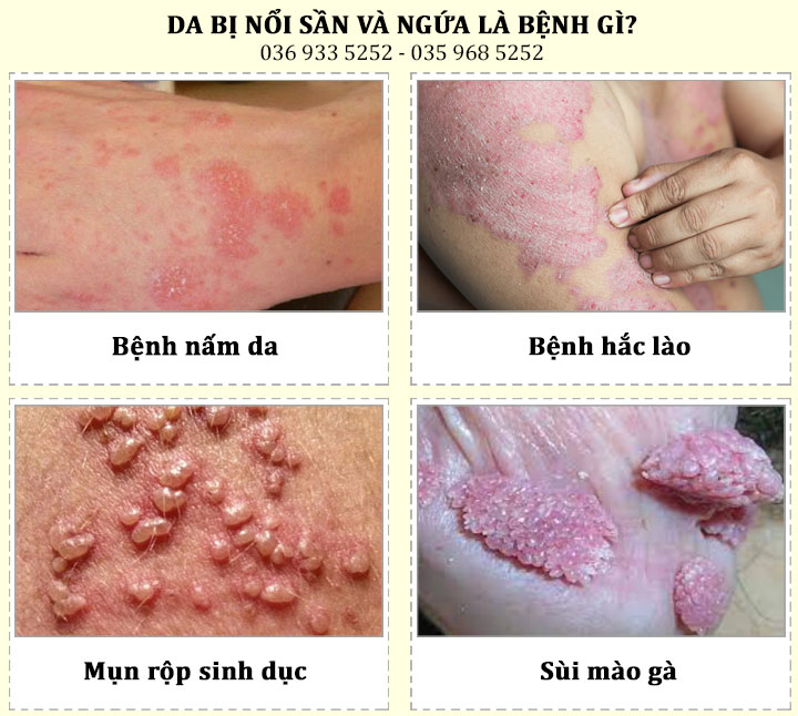 Hiện tượng da bị nổi sần và ngứa là bệnh gì?