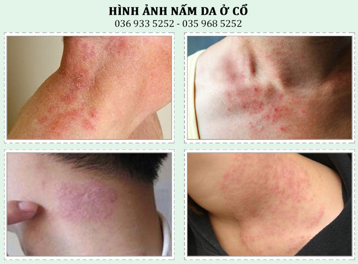 Hình ảnh bệnh nấm da ở cổ & Cách chữa trị hiệu quả