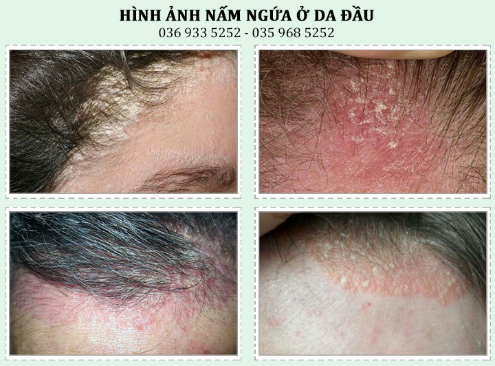 Khám nấm da đầu ở đâu uy tín và hiệu quả ở Hà Nội