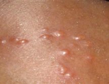 Nguyên Nhân Gây Herpes Sinh Dục