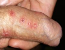 Dấu hiệu herpes sinh dục dễ nhận biết