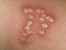 Nhận biết bệnh herpes sinh dục