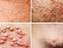 Phòng khám chữa herpes sinh dục uy tín