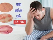 Sùi Mào Gà Là Bệnh Như Thế Nào