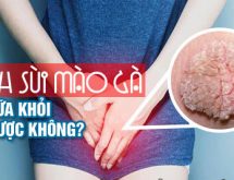 Sùi mào gà ở nữ giới có nguy hiểm không : Dấu hiệu và cách chữa hiệu quả