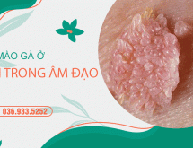 [Bác sĩ chuyên khoa chia sẻ] Cách điều trị sùi mào gà bên trong âm đạo hiệu quả, không tái phát chỉ sau liệu trình