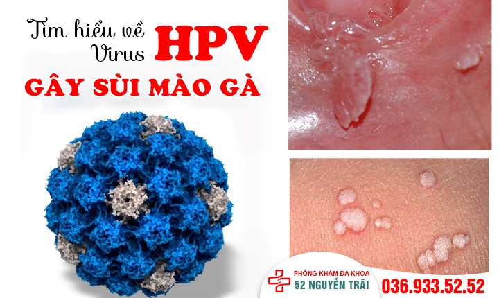 HPV gây sùi mào gà – Những thông tin cần phải nắm rõ