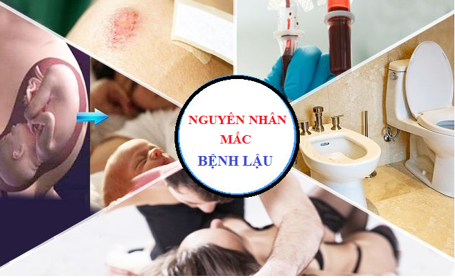 BỆNH LẬU VÀ NHỮNG NGUYÊN NHÂN KHIẾN BỆNH LẬU LÂY LAN CHÓNG MẶT