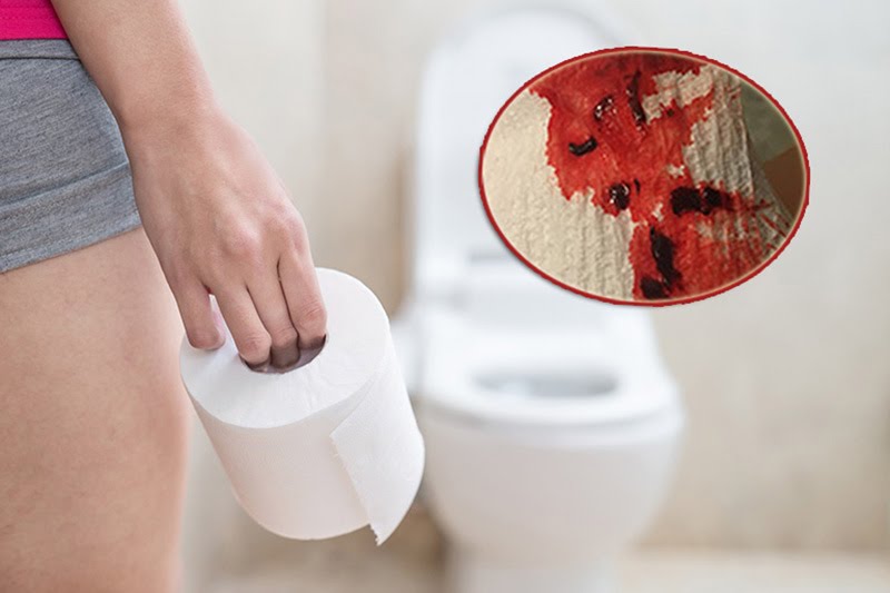 KHI NÀO CẦN THĂM KHÁM VÀ CHỮA TRỊ BỆNH TRĨ?