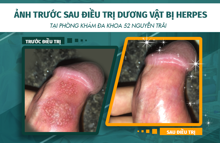 Hình ảnh trước và sau khi điều trị dương vật bị mụn rộp sinh dục herpes tại phòng khám Đa khoa 52 Nguyễn Trãi