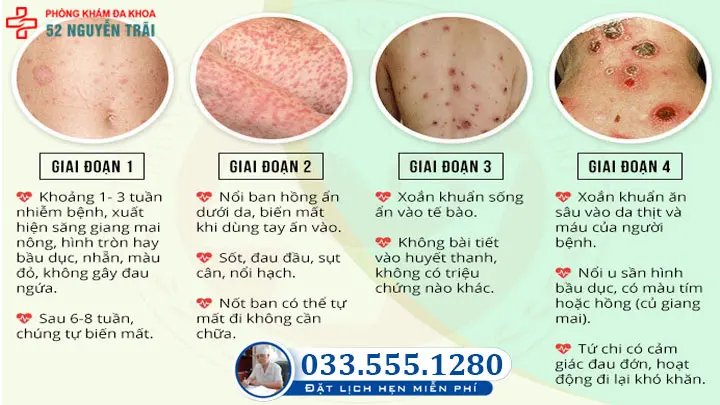 Chi phí điều trị giang mai còn liên quan đến mức độ nghiệm trọng của bệnh