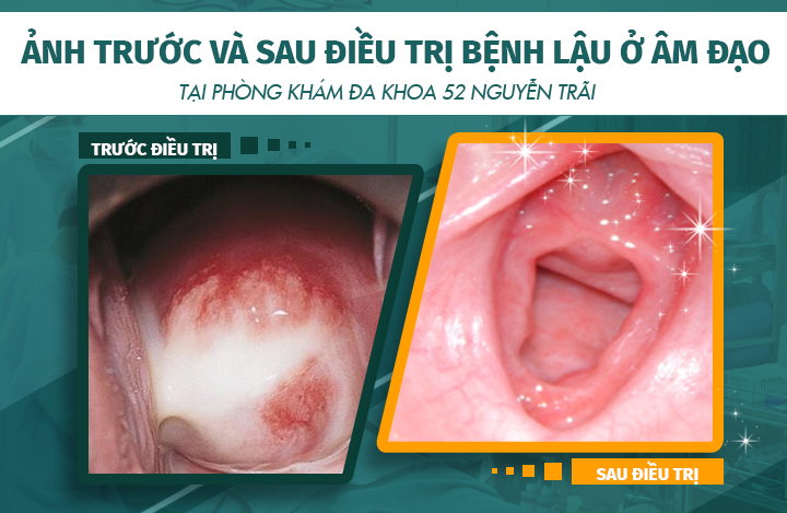 Hình ảnh trước và sau khi điều trị bệnh lậu ở âm đạo tại phòng khám Đa khoa 52 Nguyễn Trãi