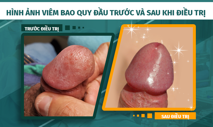 Hình ảnh trước và sau khi điều trị viêm bao quy đầu tại phòng khám Đa khoa 52 Nguyễn Trãi