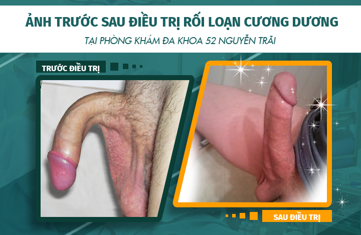 Hình ảnh trước và sau khi điều trị bệnh rối loạn cương dương tại phòng khám Đa khoa 52 Nguyễn Trãi