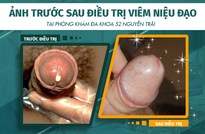 Hình ảnh trước và sau khi điều trị bệnh viêm niệu đạo tại phòng khám Đa khoa 52 Nguyễn Trãi