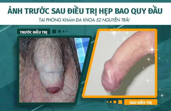 Hình ảnh trước và sau khi điều trị bệnh hẹp bao quy đầu dương vật tại phòng khám Đa khoa 52 Nguyễn Trãi