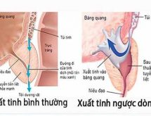 Xuất tinh ngược dòng là bệnh gì?