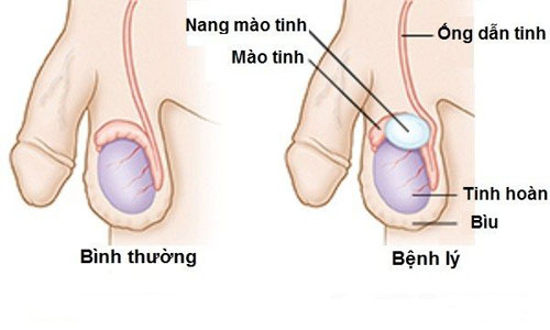 U NANG MÀO TINH LIỆU CÓ NÊN MỔ HAY KHÔNG?