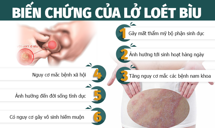 6 BIẾN CHỨNG CỦA LỞ LOÉT BÌU Ở NAM GIỚI