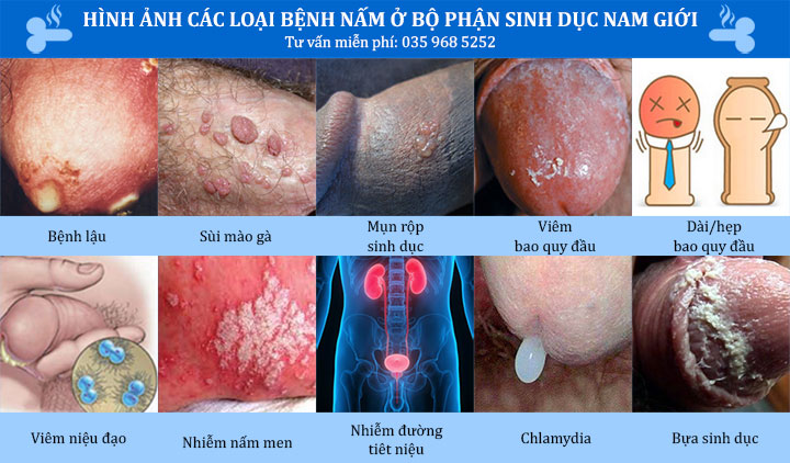 Hình ảnh các loại bệnh nấm ở bộ phận sinh dục nam giới & Cách chữa hiệu quả