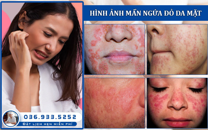 Hình ảnh triệu chứng da mặt nổi mẩn đỏ ngứa là bệnh gì?