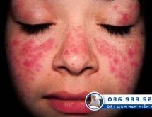 Triệu chứng da mặt nổi mẩn đỏ ngứa là bệnh gì?