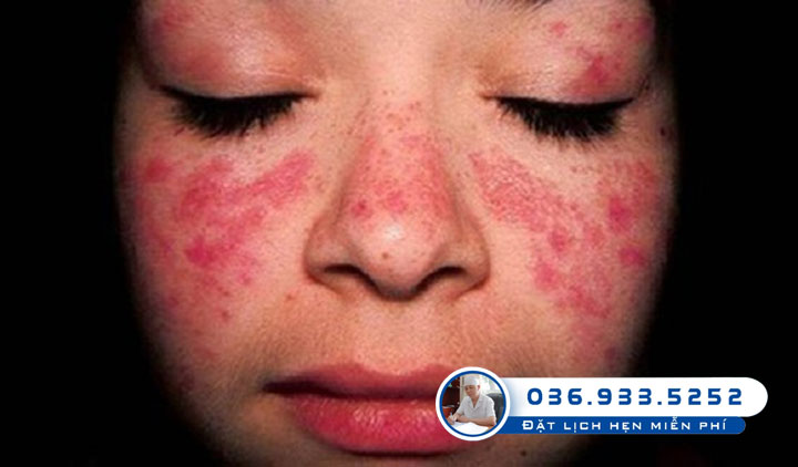 Da mặt nổi mẩn đỏ ngứa là dấu hiệu của bệnh gì?