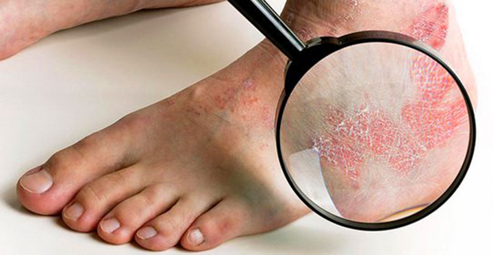Nổi mẩn ngứa đỏ ở da chân có nguy hiểm không?
