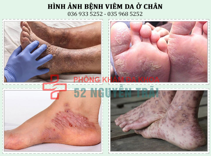 Hình ảnh bệnh viêm da ở chân