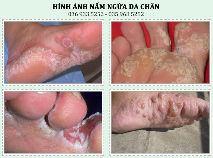 Nấm da chân: Triệu chứng, Nguyên nhân và Cách điều trị