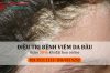 Viêm da đầu: Cách nhận biết và phương pháp điều trị