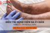 Nhận biết dấu hiệu bệnh viêm da ở chân để điều trị kịp thời