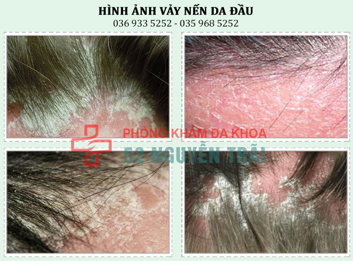Vảy nến da đầu: Những triệu chứng cần đi thăm khám ngay
