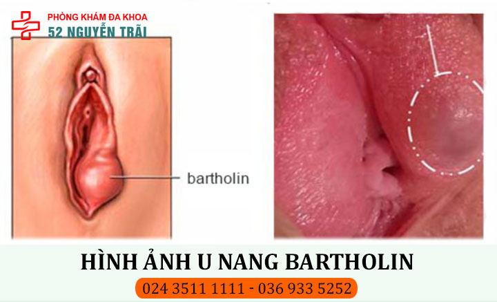 Hình ảnh u nang bartholin