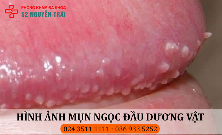 Hình ảnh mụn ngọc xung quanh đầu dương vật