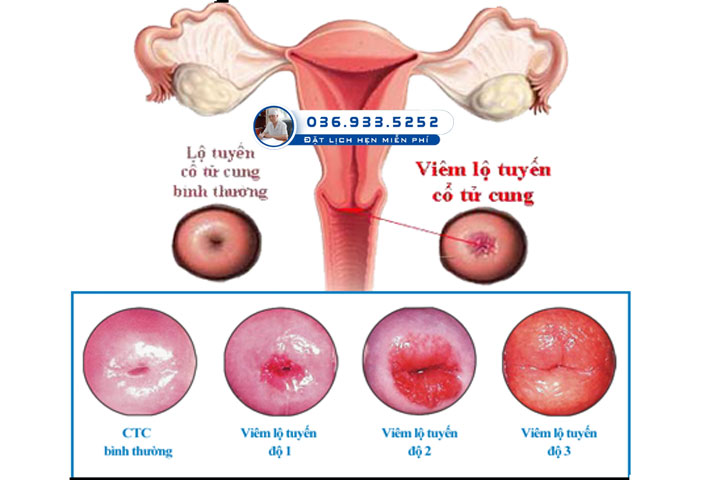 Viêm lộ tuyến cổ tử cung nếu kéo dài kéo theo nhiều ảnh hướng đến sức khoẻ sinh sản và có thể đe doạ đến tính mạng